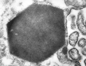F,1y. | eosinophilic granuloma - Charcot- Leyden crystal F,1y. | eosinophilic granuloma - Charcot- Leyden crystal